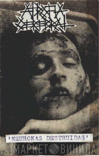 Atrofia Cerebral  - Neuronas Destruidas