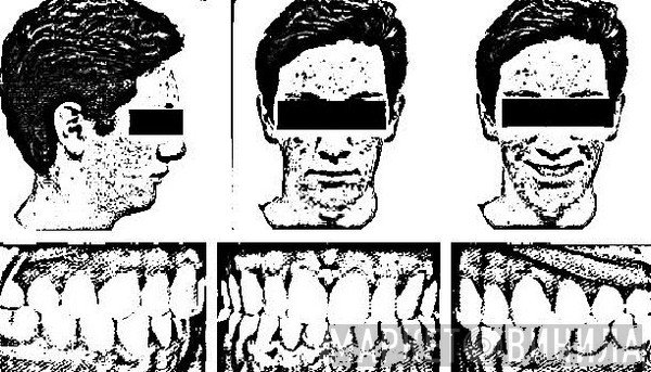 Overbite   - Demo 2013